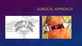 SURGICAL APPROACH
 