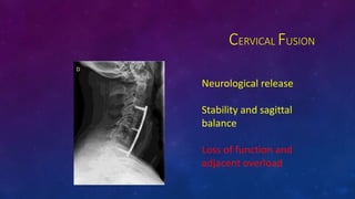 CERVICAL FUSION
Neurological release
Stability and sagittal
balance
Loss of function and
adjacent overload
 