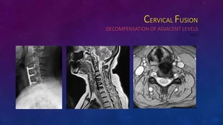 CERVICAL FUSION
DECOMPENSATION OF ADJACENT LEVELS
DECO
 