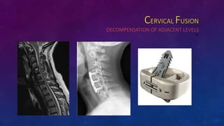CERVICAL FUSION
DECOMPENSATION OF ADJACENT LEVELS
DE
 