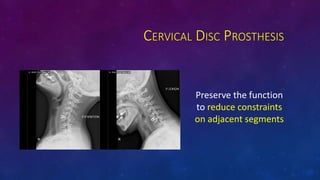 CERVICAL DISC PROSTHESIS
Preserve the function
to reduce constraints
on adjacent segments
 