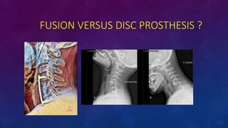 FUSION VERSUS DISC PROSTHESIS ?
 