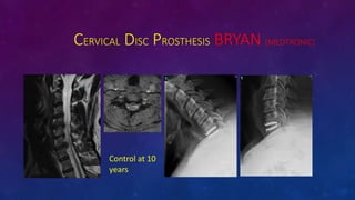 CERVICAL DISC PROSTHESIS BRYAN (MEDTRONIC)
Control at 10
years
 