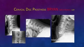 CERVICAL DISC PROSTHESIS BRYAN (MEDTRONIC) 14Y
 