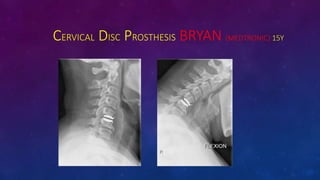 CERVICAL DISC PROSTHESIS BRYAN (MEDTRONIC) 15Y
 
