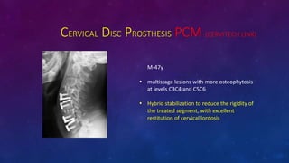 CERVICAL DISC PROSTHESIS PCM (CERVITECH LINK)
M-47y
? multistage lesions with more osteophytosis
at levels C3C4 and C5C6
? Hybrid stabilization to reduce the rigidity of
the treated segment, with excellent
restitution of cervical lordosis
 