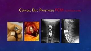 CERVICAL DISC PROSTHESIS PCM (CERVITECH LINK)
 