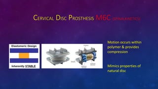 CERVICAL DISC PROSTHESIS M6C (SPINALKINETICS)
Motion occurs within
polymer & provides
compression
Mimics properties of
natural disc
 