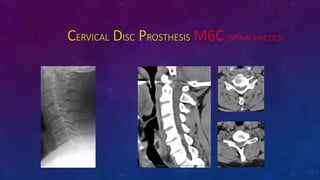 CERVICAL DISC PROSTHESIS M6C (SPINALKINETICS)
 