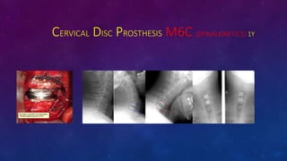 CERVICAL DISC PROSTHESIS M6C (SPINALKINETICS) 1Y
 