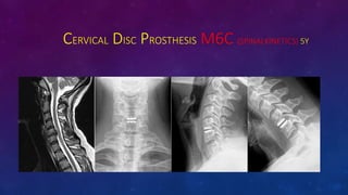 CERVICAL DISC PROSTHESIS M6C (SPINALKINETICS) 5Y
 