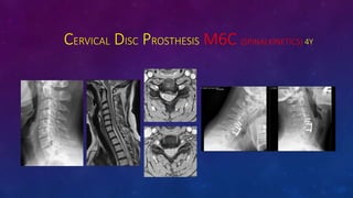 CERVICAL DISC PROSTHESIS M6C (SPINALKINETICS) 4Y
 