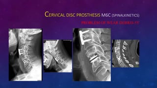 CERVICAL DISC PROSTHESIS M6C (SPINALKINETICS)
PROBLEM OF WEAR DEBRIS-5Y
 