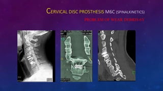 CERVICAL DISC PROSTHESIS M6C (SPINALKINETICS)
PROBLEM OF WEAR DEBRIS-6Y
 