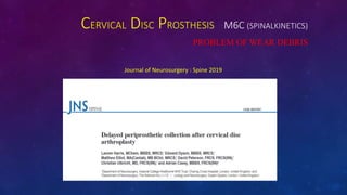 CERVICAL DISC PROSTHESIS M6C (SPINALKINETICS)
PROBLEM OF WEAR DEBRIS
Journal of Neurosurgery : Spine 2019
 