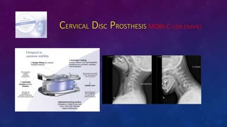 CERVICAL DISC PROSTHESIS MOBI-C (LDR ZIMVIE)
 