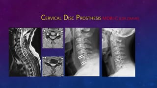 CERVICAL DISC PROSTHESIS MOBI-C (LDR ZIMVIE)
 