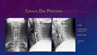 CERVICAL DISC PROSTHESIS MOBI-C (LDR ZIMVIE)
M 48y
Corporectomy
Fusion C4-C7
Mobi-C C3C4
Controle
4y
 