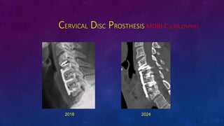 CERVICAL DISC PROSTHESIS MOBI-C (LDR ZIMVIE)
2018
2018 2024
 
