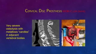 CERVICAL DISC PROSTHESIS MOBI-C (LDR ZIMVIE)
Very severe
osteolysis with
metallosis candles
in adjacent
vertebral bodies
 