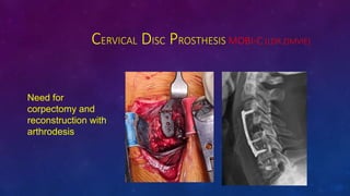 CERVICAL DISC PROSTHESIS MOBI-C (LDR ZIMVIE)
Need for
corpectomy and
reconstruction with
arthrodesis
 