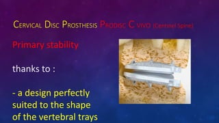 CERVICAL DISC PROSTHESIS PRODISC C VIVO (Centinel Spine)
Primary stability
thanks to :
- a design perfectly
suited to the shape
of the vertebral trays
 
