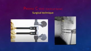 PRODISC C VIVO (Centinel Spine)
Surgical technique
 