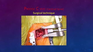 PRODISC C VIVO (Centinel Spine)
Surgical technique
 