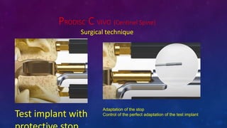 PRODISC C VIVO (Centinel Spine)
Surgical technique
Test implant with
Adaptation of the stop
Control of the perfect adaptation of the test implant
 