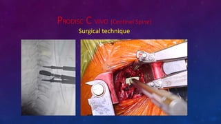 PRODISC C VIVO (Centinel Spine)
Surgical technique
 
