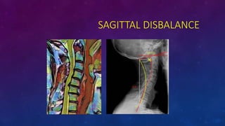 SAGITTAL DISBALANCE
 
