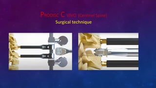 PRODISC C VIVO (Centinel Spine)
Surgical technique
 