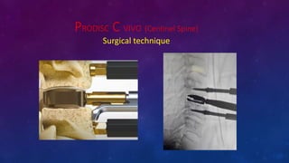 PRODISC C VIVO (Centinel Spine)
Surgical technique
 