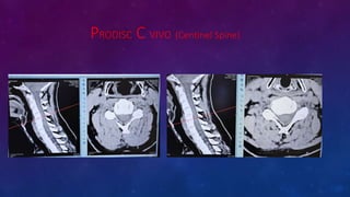 PRODISC C VIVO (Centinel Spine)
 