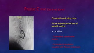 PRODISC C VIVO (Centinel Spine)
Chrome-Cobalt alloy trays
Fixed Polyethylene Core of
specific radius
to provides:
- Controlled, predictable
motion
- Controlled translation
coupled with flexion-extension
 