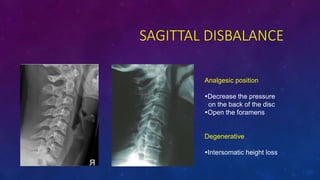 SAGITTAL DISBALANCE
Analgesic position
?Decrease the pressure
on the back of the disc
?Open the foramens
Degenerative
?Intersomatic height loss
 