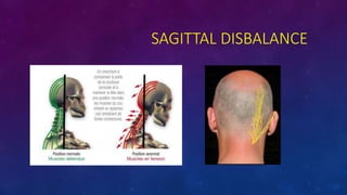 SAGITTAL DISBALANCE
 