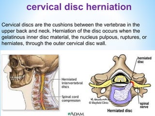Cervical disc herination.pptx