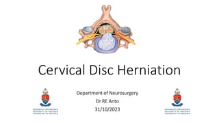 Cervical Disc Herniation
Department of Neurosurgery
Dr RE Anto
31/10/2023
 