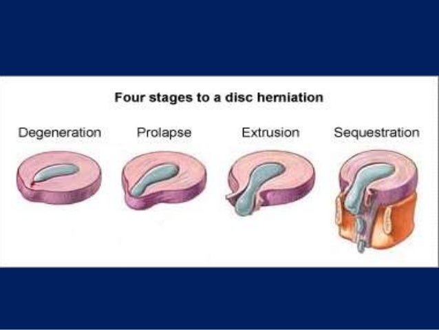 Cervical disc prolapse