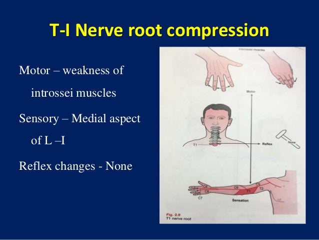 Cervical disc prolapse Cervical disc prolapse