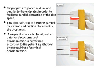 CERVICAL SPINE INTERVERTEBRAL DISC REPLACEMENT.pptx