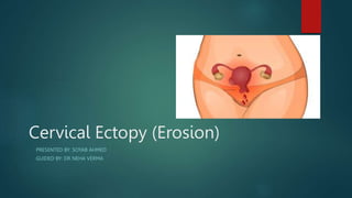 Cervical Ectopy (Erosion)
PRESENTED BY: SOYAB AHMED
GUIDED BY: DR NEHA VERMA
 