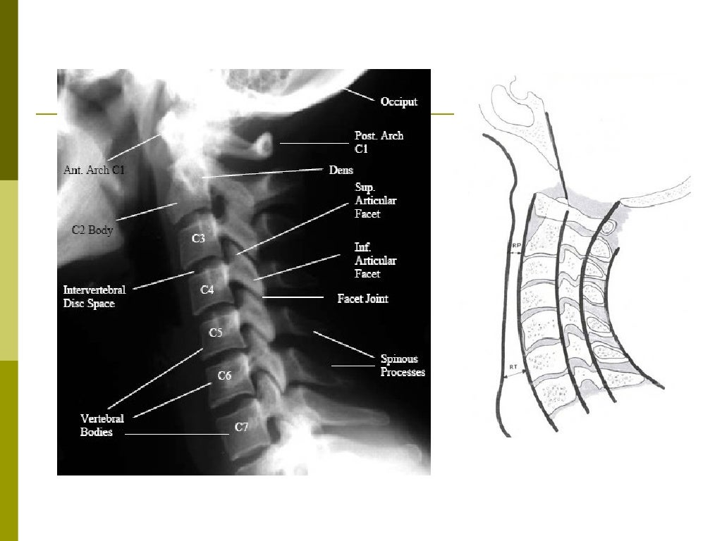 Cervical fracture