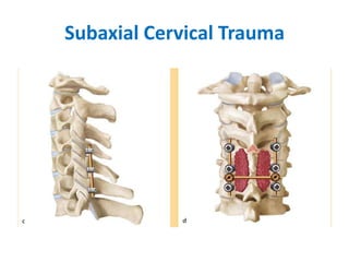Subaxial Cervical Trauma

 