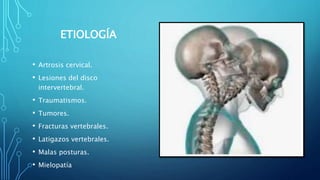 ETIOLOGÍA
• Artrosis cervical.
• Lesiones del disco
intervertebral.
• Traumatismos.
• Tumores.
• Fracturas vertebrales.
• Latigazos vertebrales.
• Malas posturas.
• Mielopatía
 