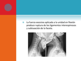  La fuerza excesiva aplicada a la unidad en flexión 
produce ruptura de los ligamentos interespinosos 
y subluxación de la faceta. 
 