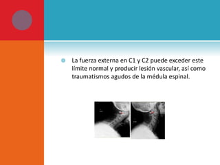  La fuerza externa en C1 y C2 puede exceder este 
límite normal y producir lesión vascular, así como 
traumatismos agudos de la médula espinal. 
 