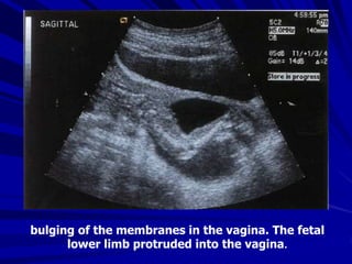 bulging of the membranes in the vagina. The fetal
lower limb protruded into the vagina.
 