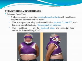 Minerva Rigit Cervical Injury : Evaluation and Management.pptx